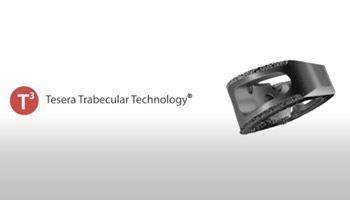 Tesera Trabecular Technology (Spine)